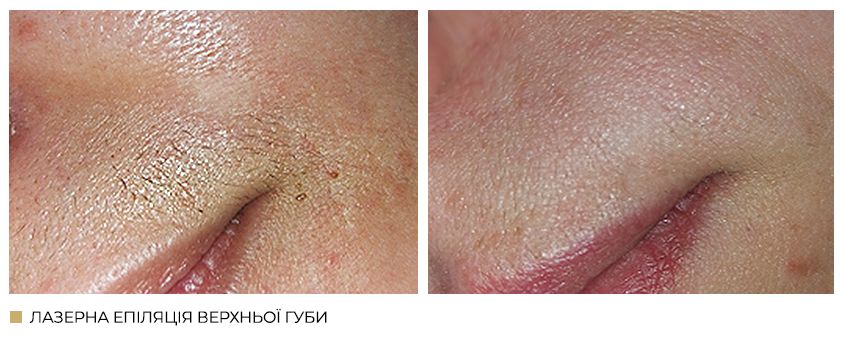 Лазерна епіляція