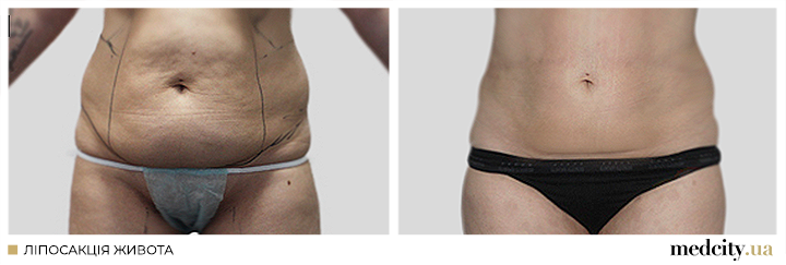 ліпо-живота-4.png