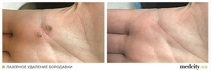 бородавка4 РОС.png бородавка4 РОС.png