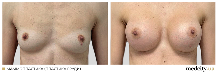 Мамопластика1ру.png