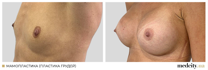 Мамопластика6.png