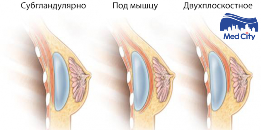 Варианты установки грудного импланта