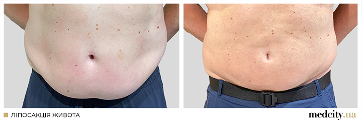 ліпо-живота-3.png ліпо-живота-3.png