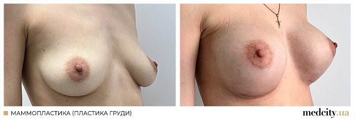 Мамопластика4ру.png