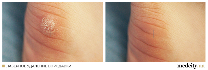 бородавка2 РОС.png бородавка2 РОС.png