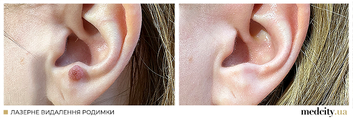 родимка1 укр.png