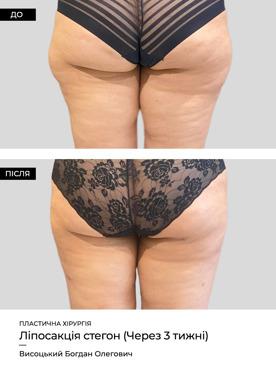 Как убрать «ушки-галифе» на бедрах