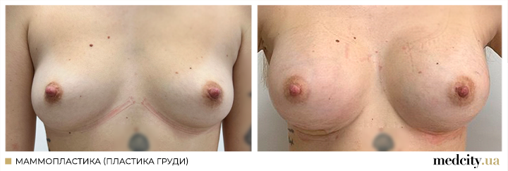 Мамопластика5ру.png