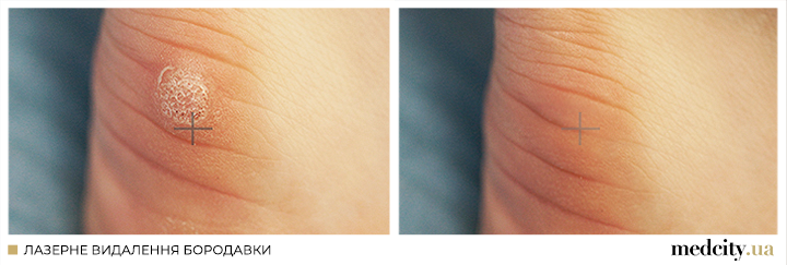 бородавка2 УКР.png бородавка2 УКР.png