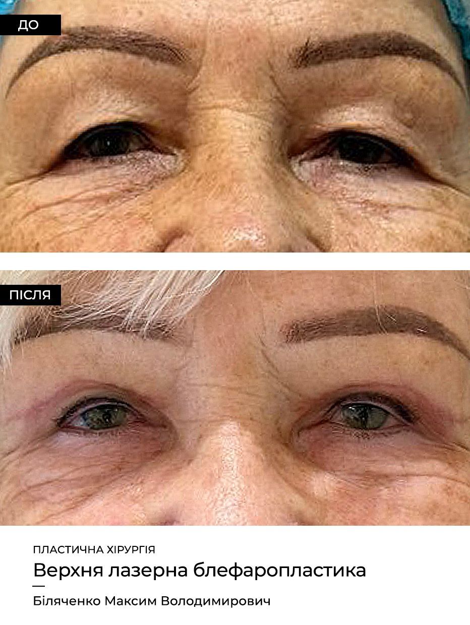Подтяжка век Опущение века