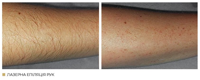 Лазерна епіляція