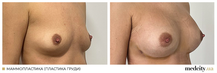 Мамопластика2ру.png