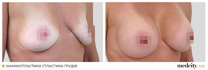 Мамопластика7ру.png