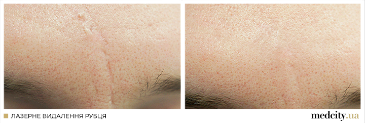 рубці 4 укр.png