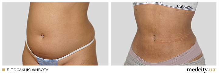 ліпо-живота-2.png