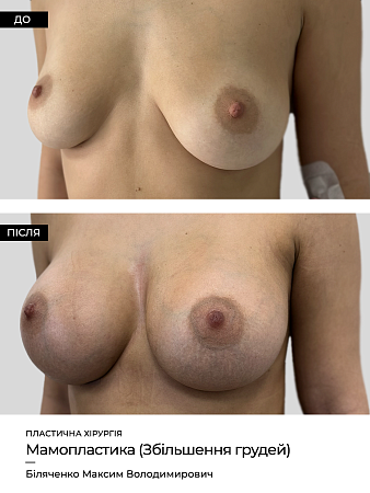 Маммопластика 34 фото до и после процедуры