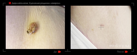 Удаление родинок 51 фото до и после процедуры