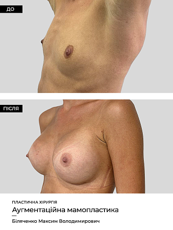 Маммопластика 20 фото до и после процедуры