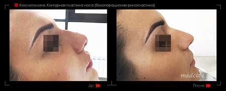 Контурная пластика носа фото до и после процедуры