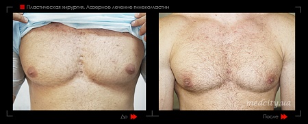 Гинекомастия 47 фото до и после процедуры