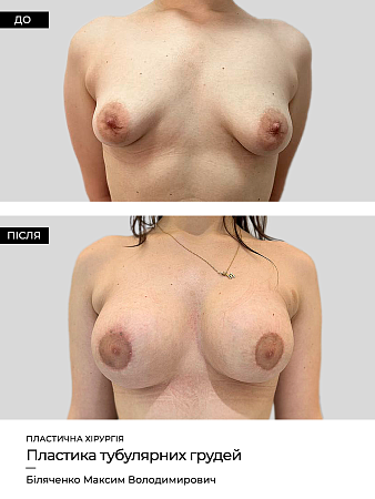 Mammoplastika 5 фото до и после процедуры