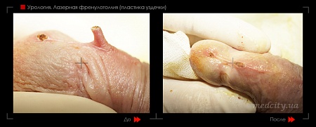 Лазерная френулотомия  фото до и после процедуры
