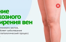 Самый эффективный метод лечения варикоза