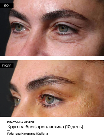 Блефаропластика круговая фото до и после процедуры