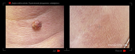 Удаление родинок 97 фото до и после процедуры