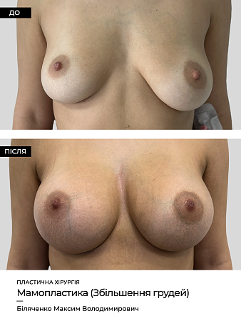 Маммопластика 35 фото до и после процедуры