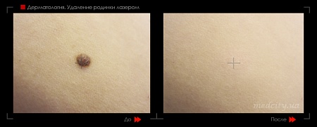 Удаление родинок13 фото до и после процедуры