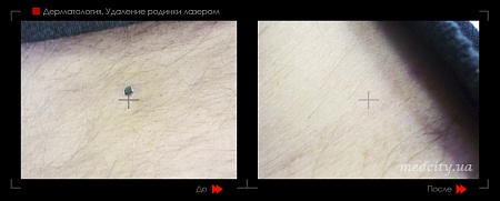 Удаление родинок 63 фото до и после процедуры