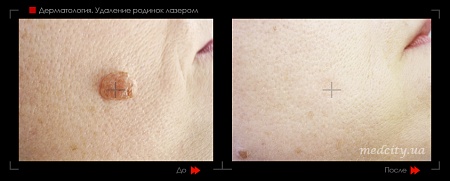Удаление родинок 30 фото до и после процедуры
