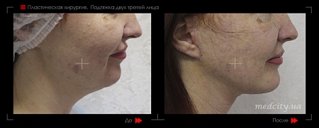 Подтяжка лица 6 фото до и после процедуры