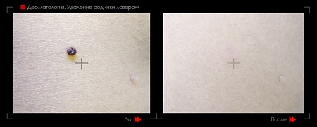 Удаление родинок 52 фото до и после процедуры