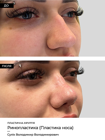 Ринопластика 25 фото до и после процедуры