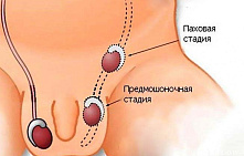 Крипторхизм