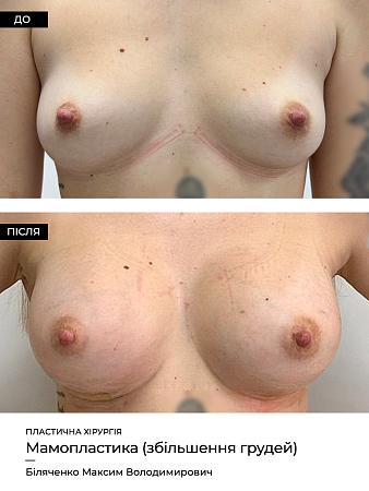 Маммопластика 15 фото до и после процедуры