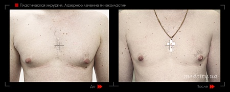 Гинекомастия 35 фото до и после процедуры