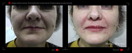 Контурная пластика периоральной зоны 4 фото до и после процедуры