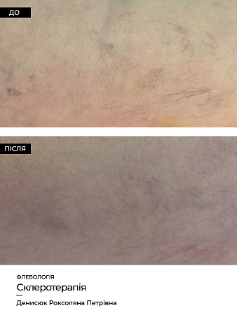 Склеротерапия 18 фото до и после процедуры