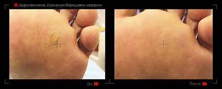 Лазерное удаление бородавок 23 фото до и после процедуры