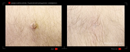 Удаление родинок 34 фото до и после процедуры