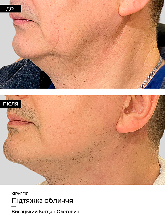 Podtyazhka Lica 2 фото до и после процедуры