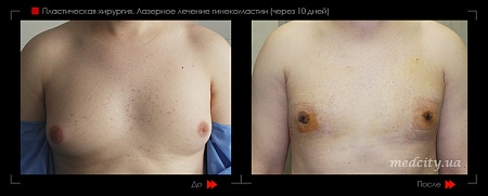 Гинекомастия 51 фото до и после процедуры