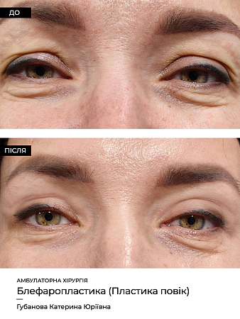 Блефаропластика фото до и после процедуры