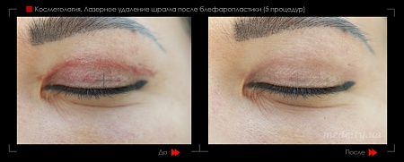 Шлифовка рубца 12 фото до и после процедуры