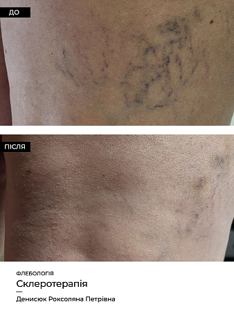 Склеротерапия 13 фото до и после процедуры