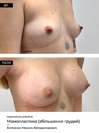Маммопластика 13 фото до и после процедуры