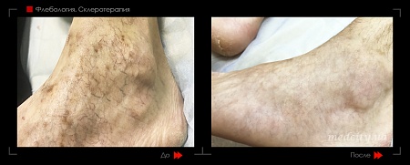 Склеротерапия 21 фото до и после процедуры